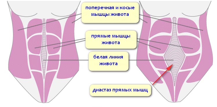 что такое диастаз